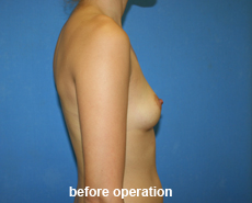 plastic-surgery-breast-augmentation